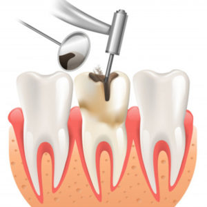 Terapia endodontica