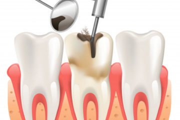 Terapia endodontica